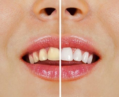 Blanquear el techo casera los dientes