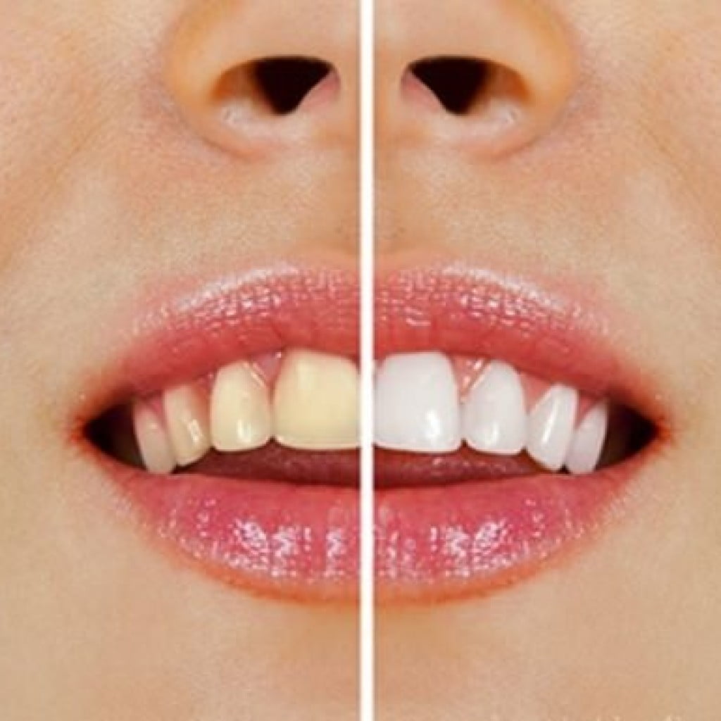 trucos caseros para blanquear los dientes