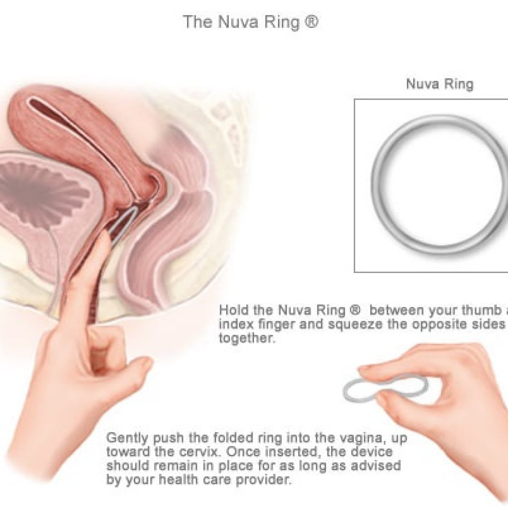 cómo se pone el anillo anticonceptivo