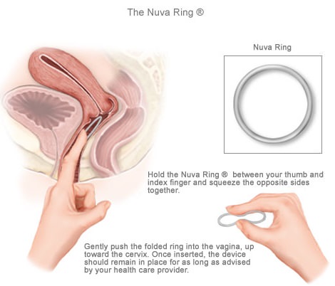 cómo se pone el anillo anticonceptivo