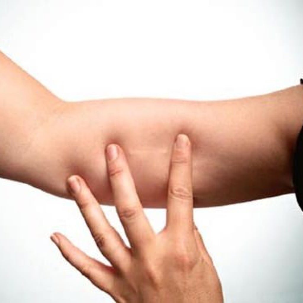 anticonceptivo subdermico