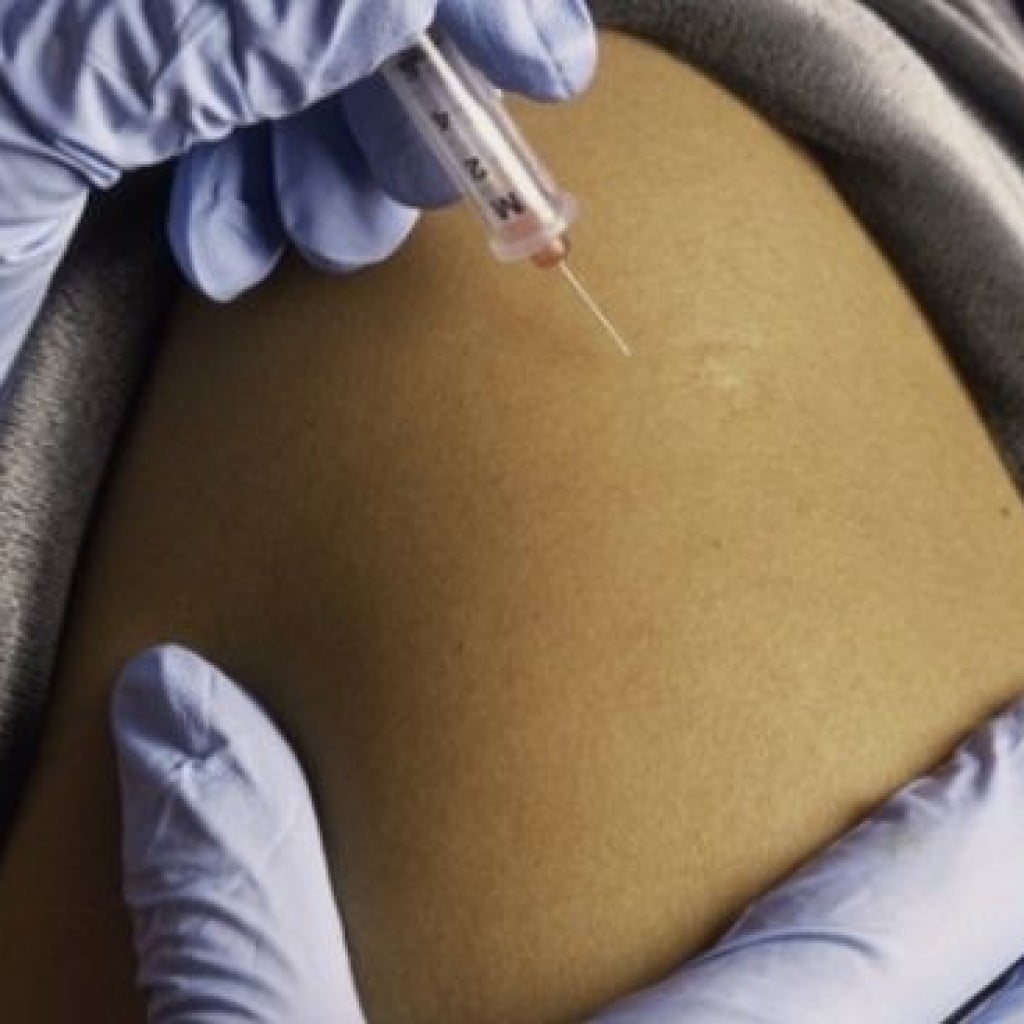 inyección anticonceptiva