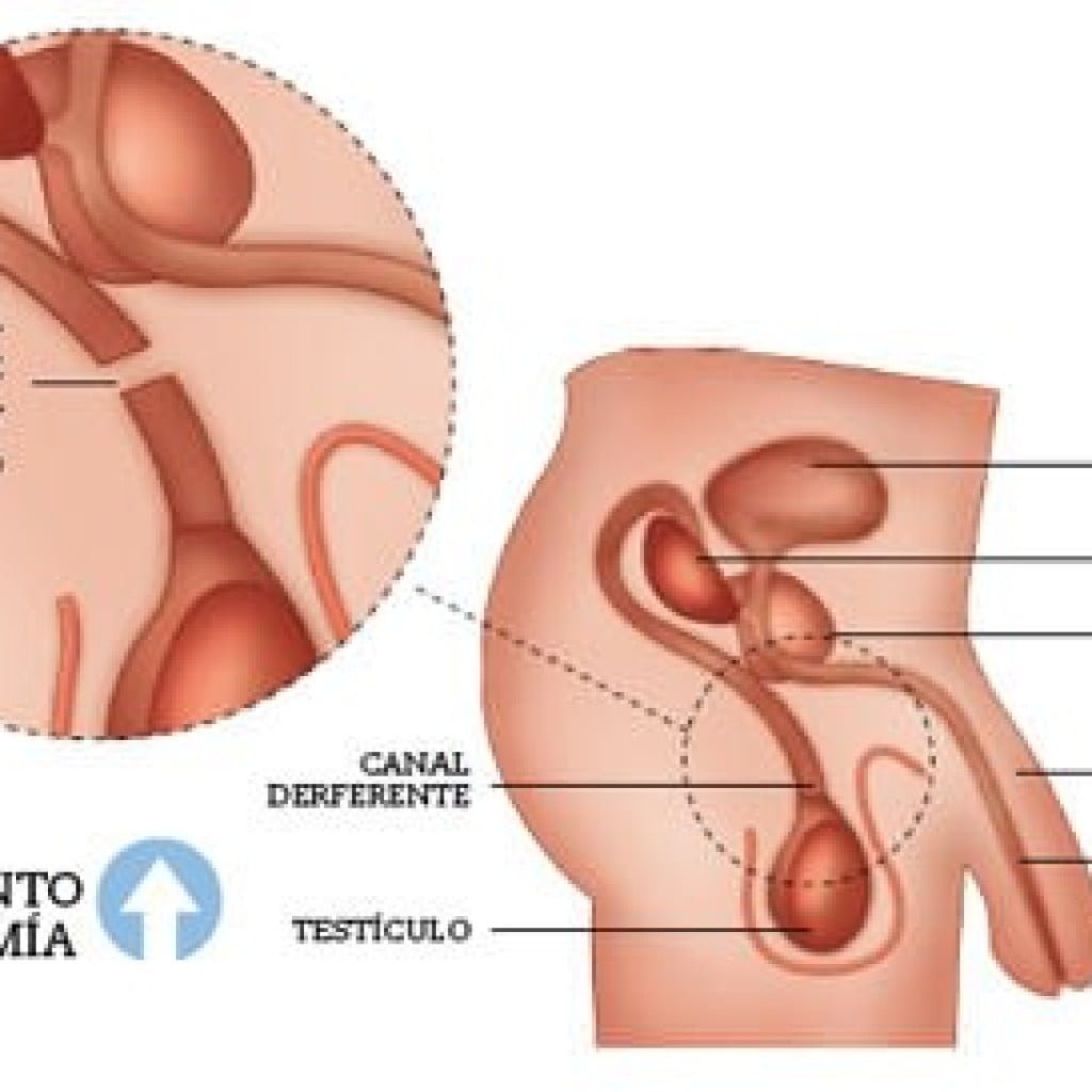 vasectomía procedimiento