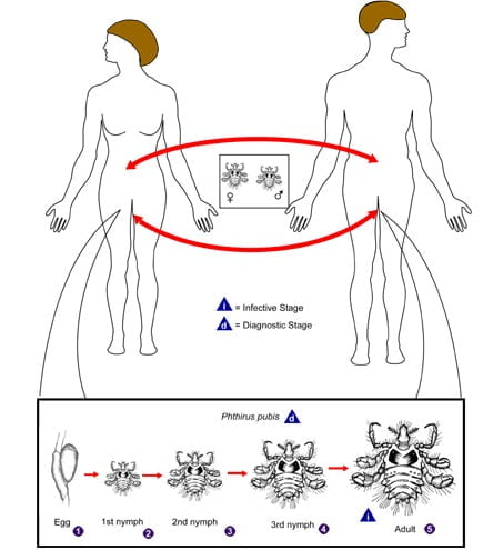 Que son los phthirus pubis y cómo eliminarlos