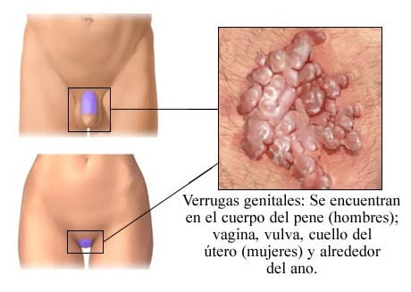 Las verrugas anales: síntomas y tratamiento